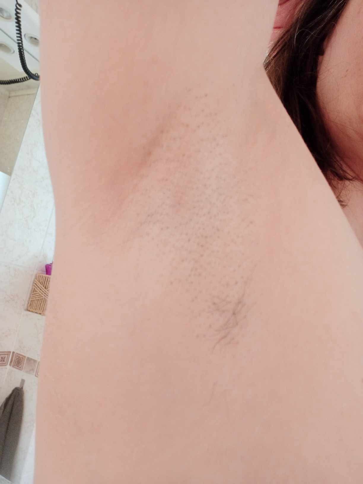 Après épilation laser