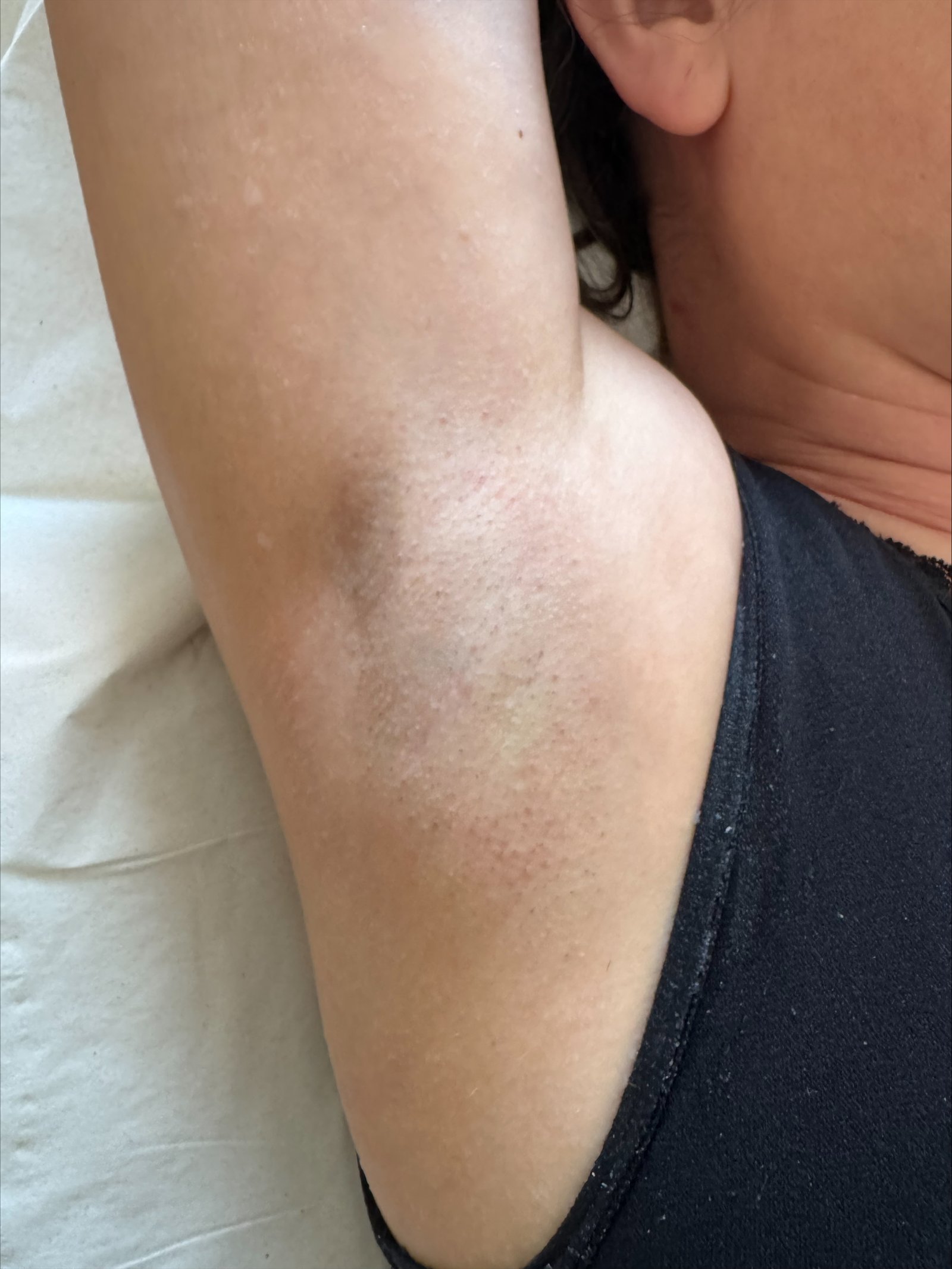 Avant épilation laser